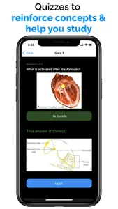 ECG / EKG Explained Clearly screenshot 3