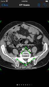 iAnkylosingSpondylitis Pro screenshot 6