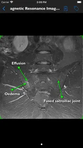 iAnkylosingSpondylitis Pro screenshot 7