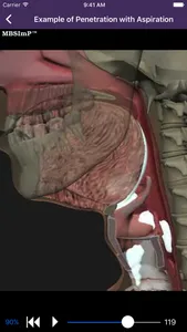 Dysphagia screenshot 1