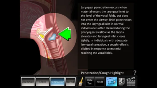 Aspiration Disorders screenshot 1