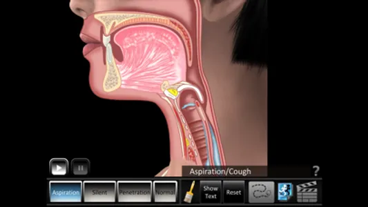 Aspiration Disorders screenshot 2