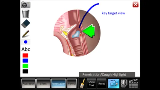 Aspiration Disorders screenshot 4