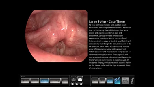 Vocal Pathology: Polyps screenshot 1