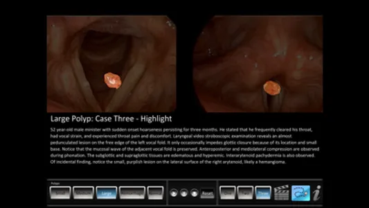 Vocal Pathology: Polyps screenshot 2