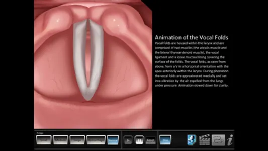 Vocal Pathology: Polyps screenshot 4