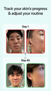 Glass: AI Skincare & Acne Scan screenshot 4