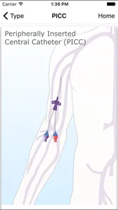 Catheter - patient version screenshot 1