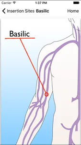 Catheter - patient version screenshot 2