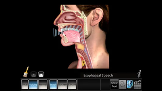 Laryngectomy screenshot 1