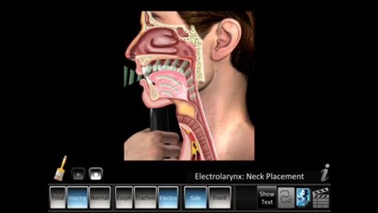 Laryngectomy screenshot 2