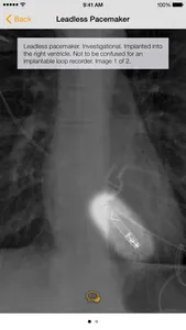 Medical Devices on Chest X-Ray screenshot 0