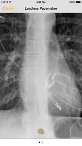 Medical Devices on Chest X-Ray screenshot 1