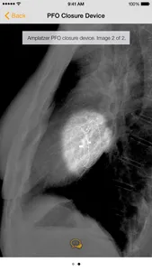 Medical Devices on Chest X-Ray screenshot 2